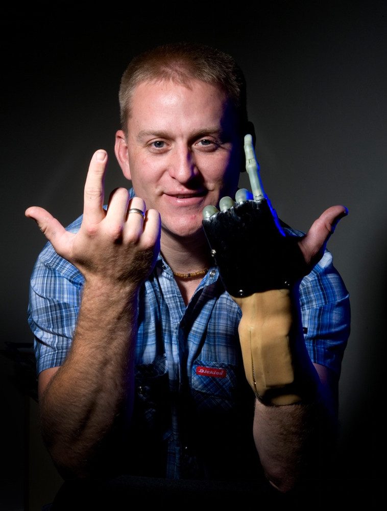 A man using a bionic upper-limb prosthetic hand.